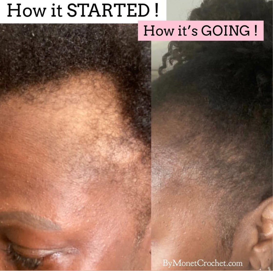 Grow My Edges Back Hair System -