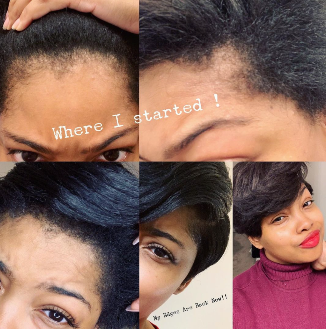 Grow My Edges Back Hair System -