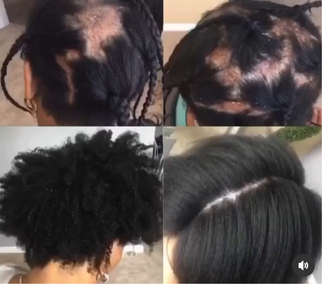 Grow My Edges Back Hair System -